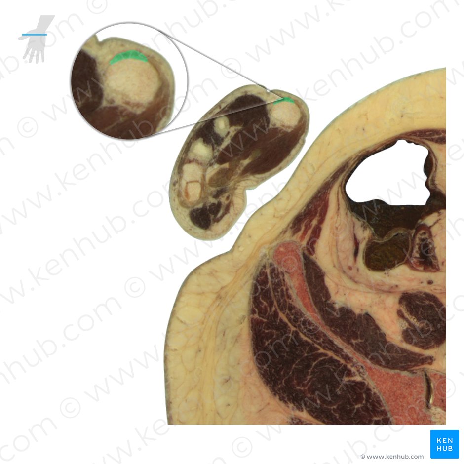 Tendon of extensor pollicis longus muscle (Tendo musculi extensoris pollicis longi); Image: National Library of Medicine