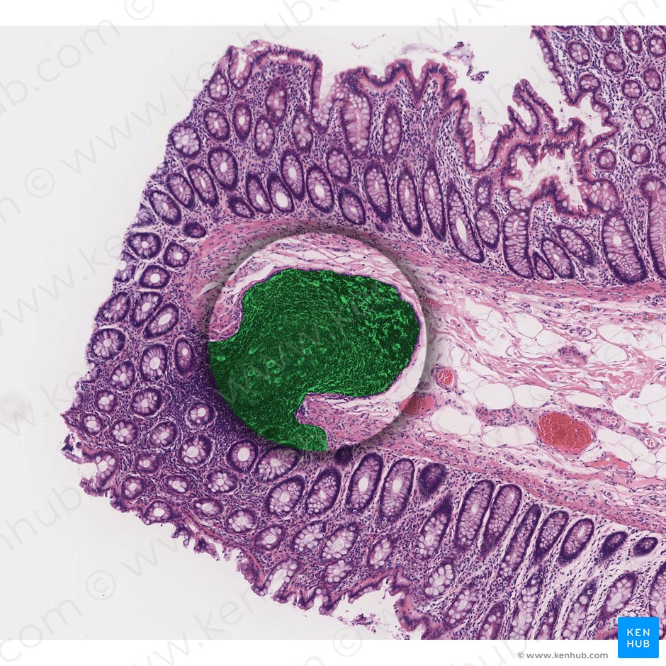 Lymphoid nodule (Nodulus lymphoideus); Image: 