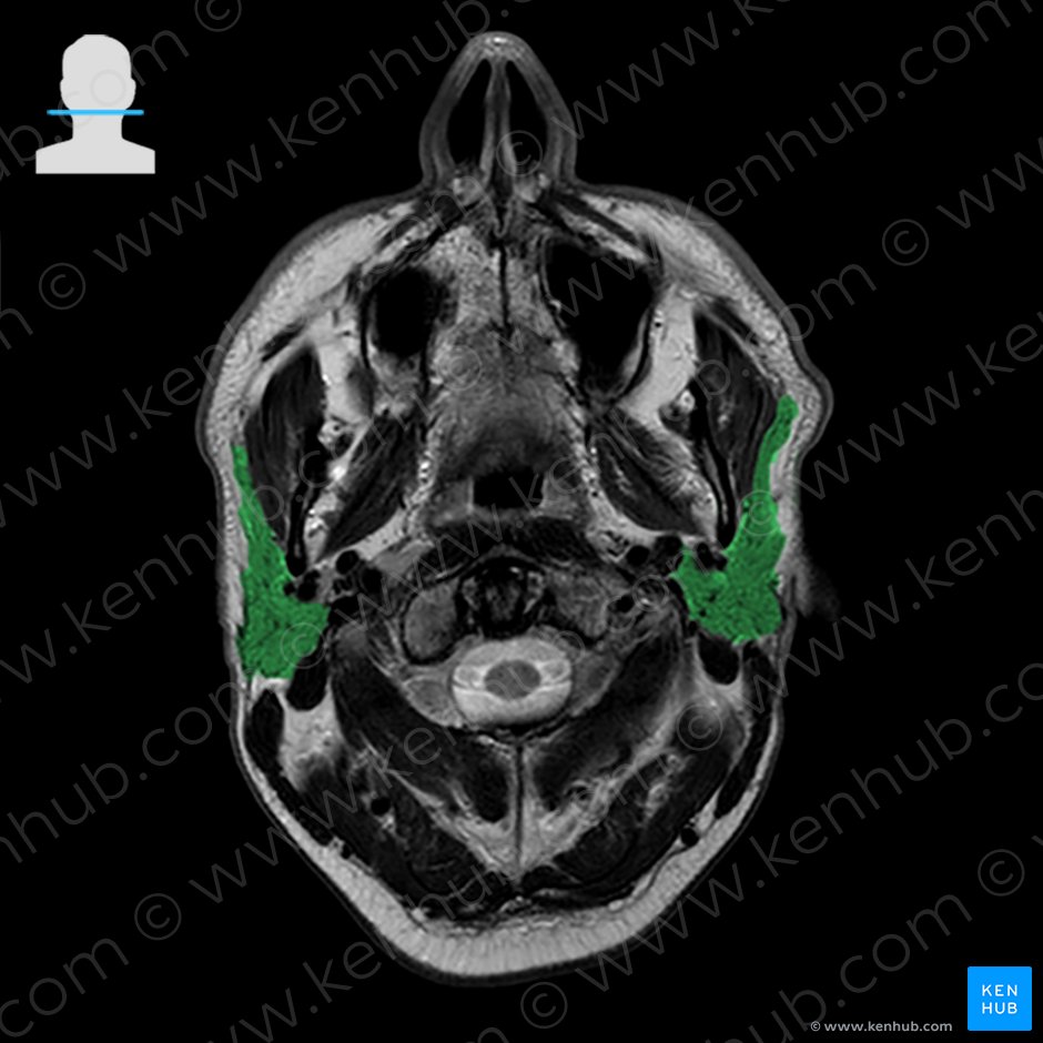 Glândula parótida (Glandula parotidea); Imagem: 