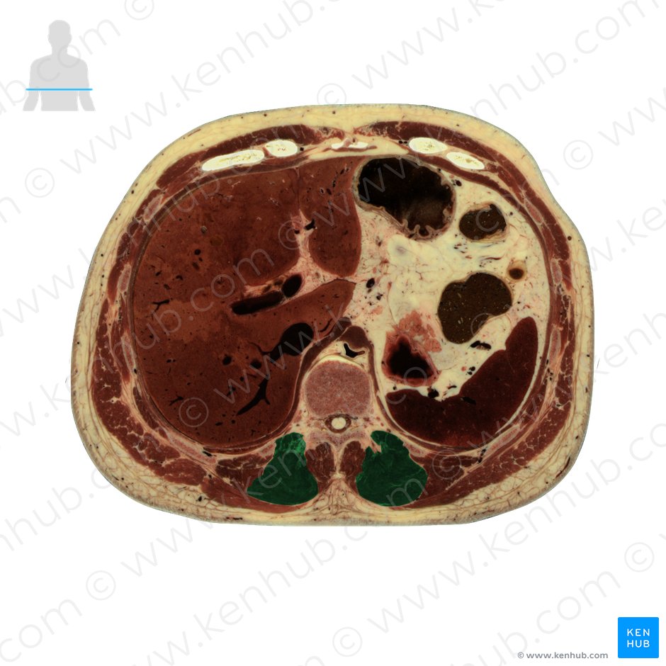 Músculo longuíssimo do tórax (Musculus longissimus thoracis); Imagem: National Library of Medicine