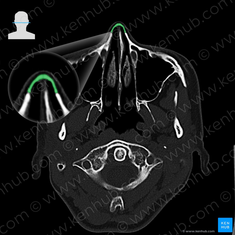 Nasal bone (Os nasale); Image: 