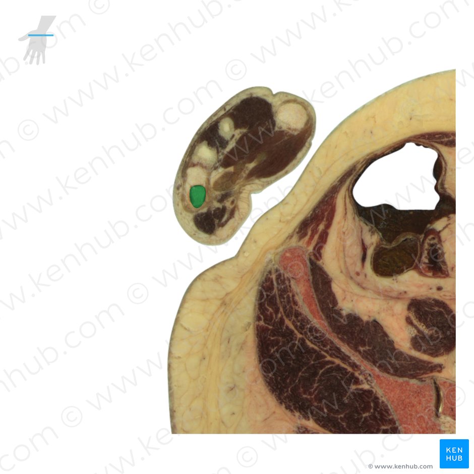 Base of 5th metacarpal bone (Basis ossis metacarpi 5); Image: National Library of Medicine