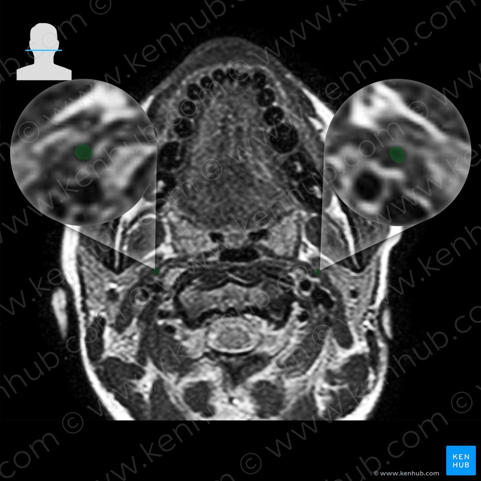 Processus styloideus ossis temporalis (Griffelfortsatz des Schläfenbeins); Bild: 