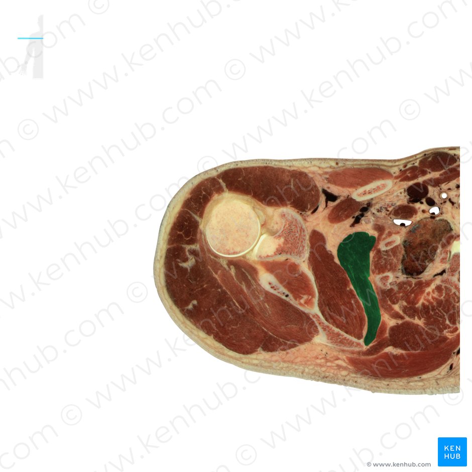 Serratus anterior muscle (Musculus serratus anterior); Image: National Library of Medicine