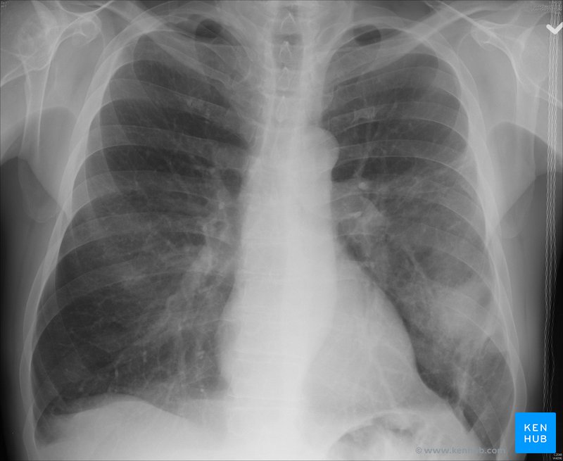 Pneumonia chest X-ray