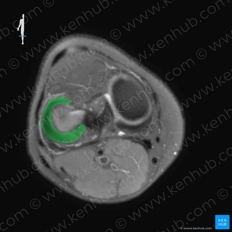 Menisco lateral (Meniscus lateralis); Imagen: 
