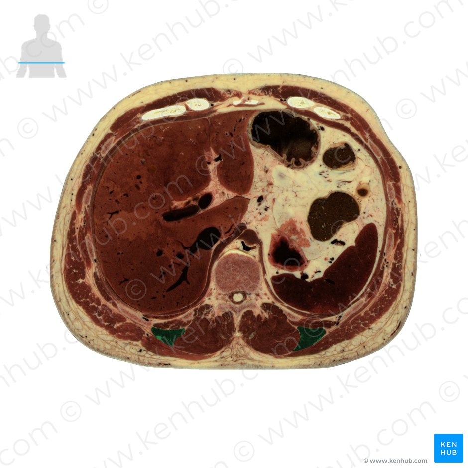Músculo iliocostal lombar (Musculus iliocostalis lumborum); Imagem: National Library of Medicine