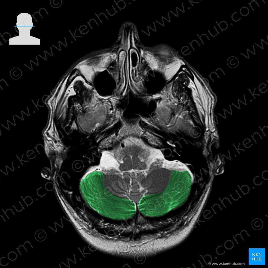 Inferior semilunar lobule (Lobulus semilunaris inferior); Image: 