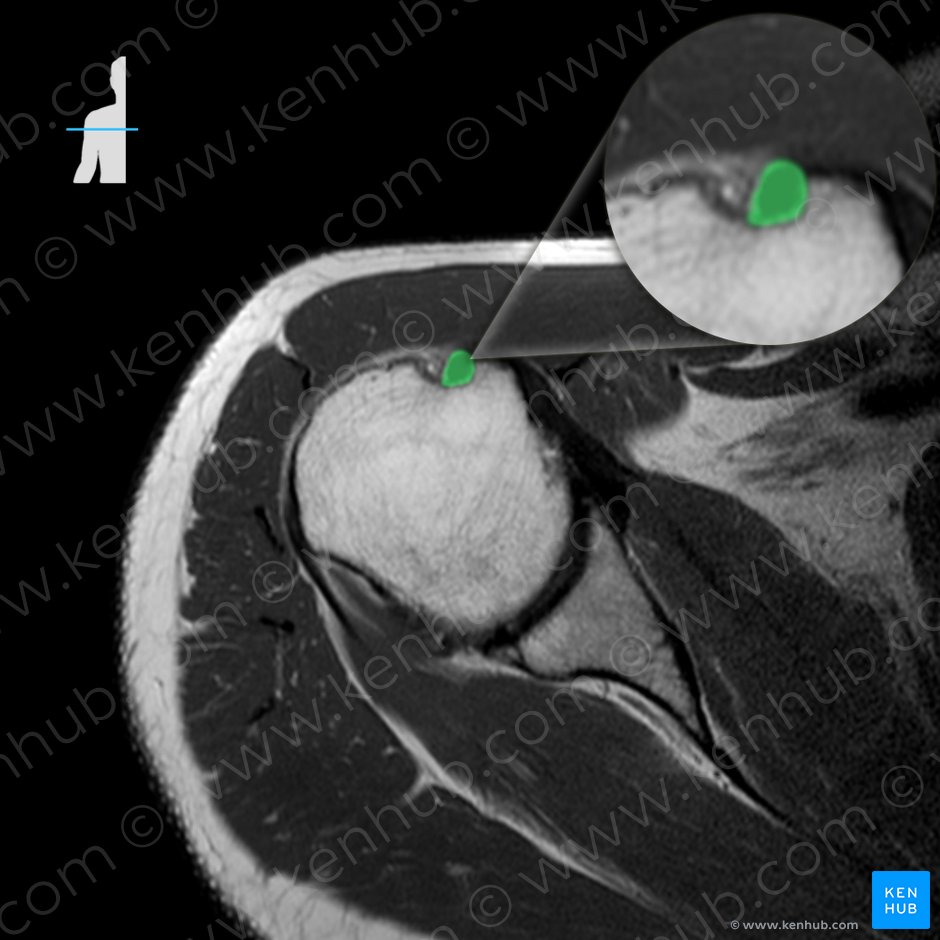 Tendon of long head of biceps brachii muscle (Tendo capitis longi musculi bicipitis brachii); Image: 