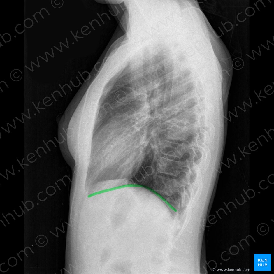 Left hemidiaphragm (Hemidiaphragma sinister); Image: 
