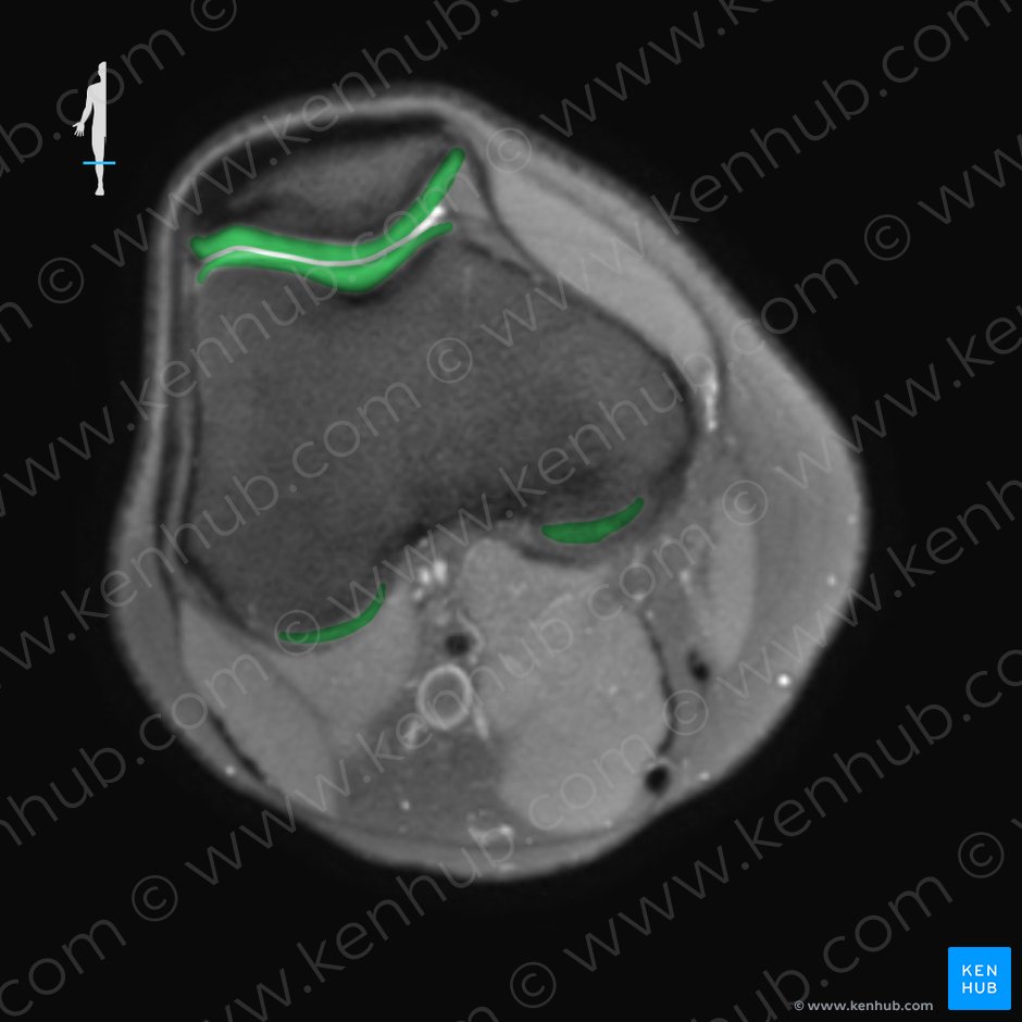 Articular cartilage of knee joint (Cartilago articularis genus); Image: 