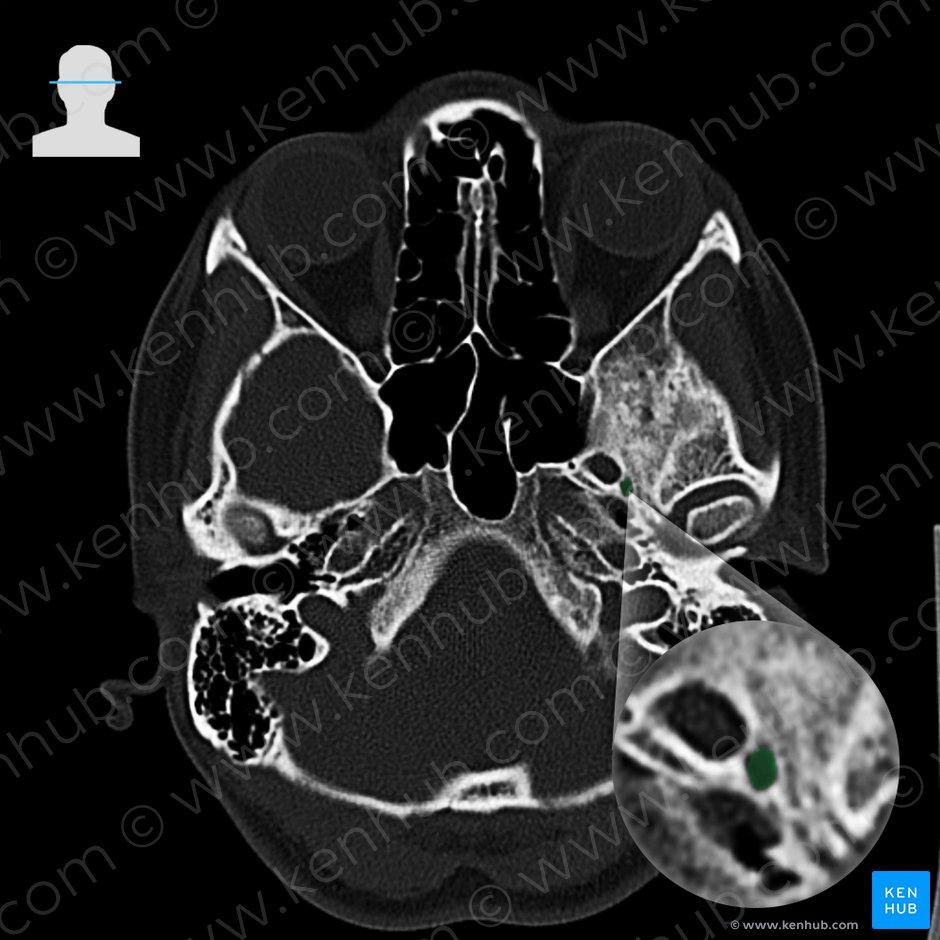 Foramen spinosum; Image: 