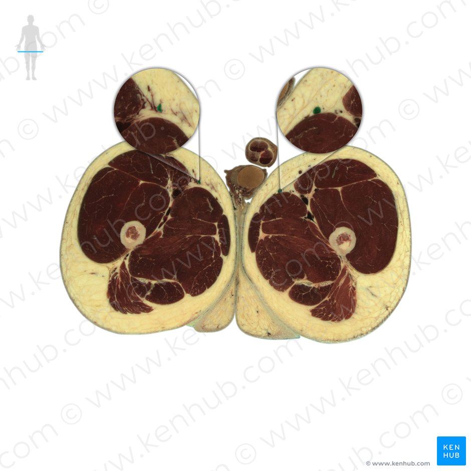 Great saphenous vein (Vena saphena magna); Image: National Library of Medicine