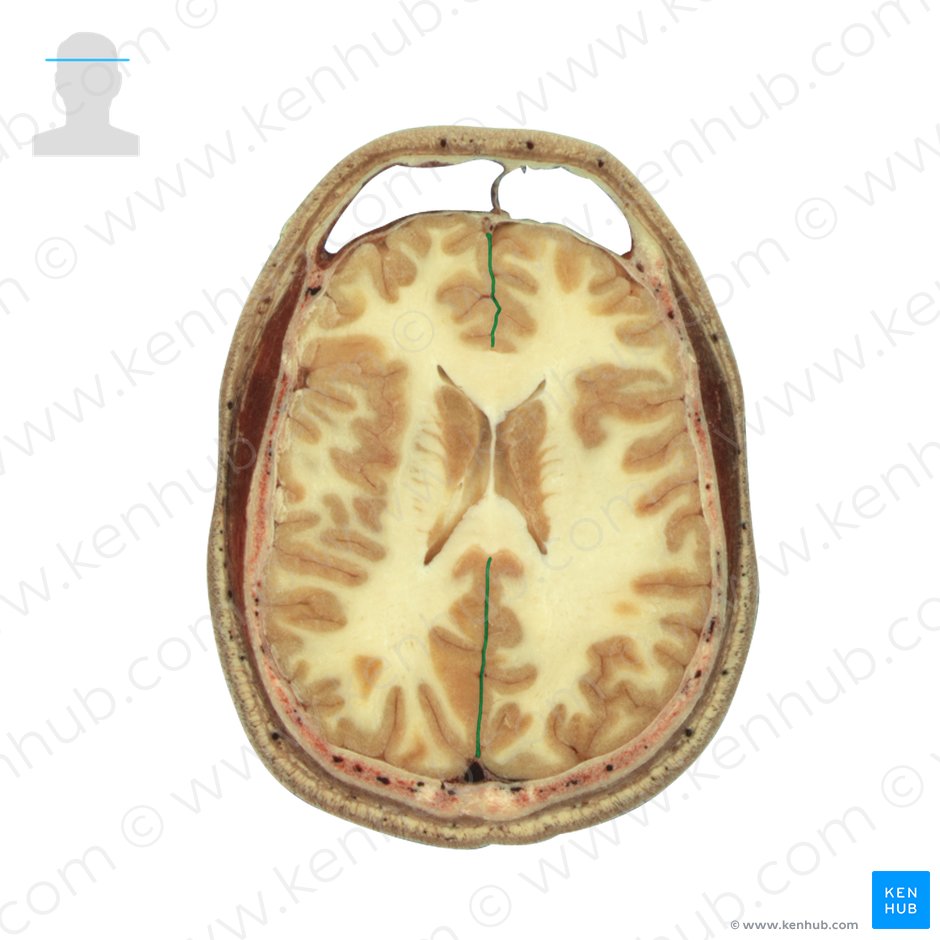 Fissura cerebral longitudinal (Fissura longitudinalis cerebri); Imagem: National Library of Medicine