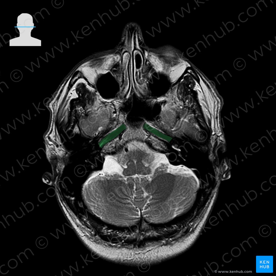 Internal carotid artery (Arteria carotis interna); Image: 