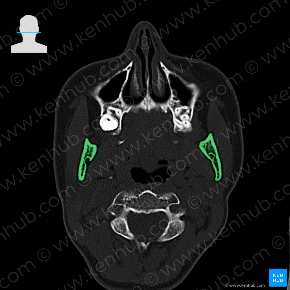 Ramus mandibulae (Aufsteigender Ast des Unterkieferknochens); Bild: 