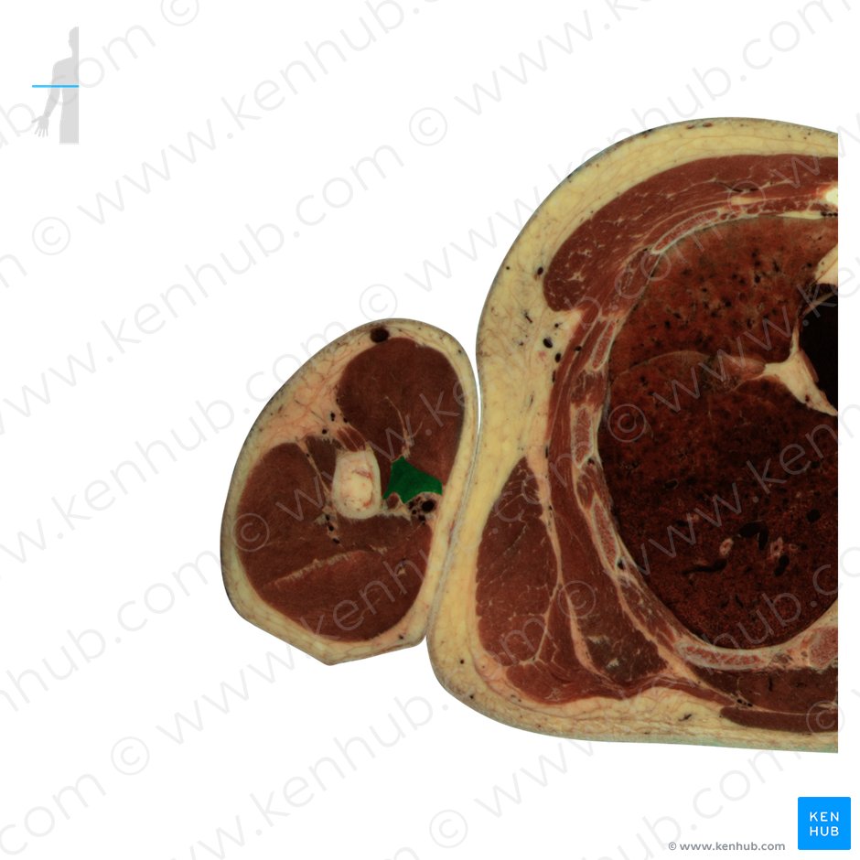 Músculo coracobraquial (Musculus coracobrachialis); Imagem: National Library of Medicine