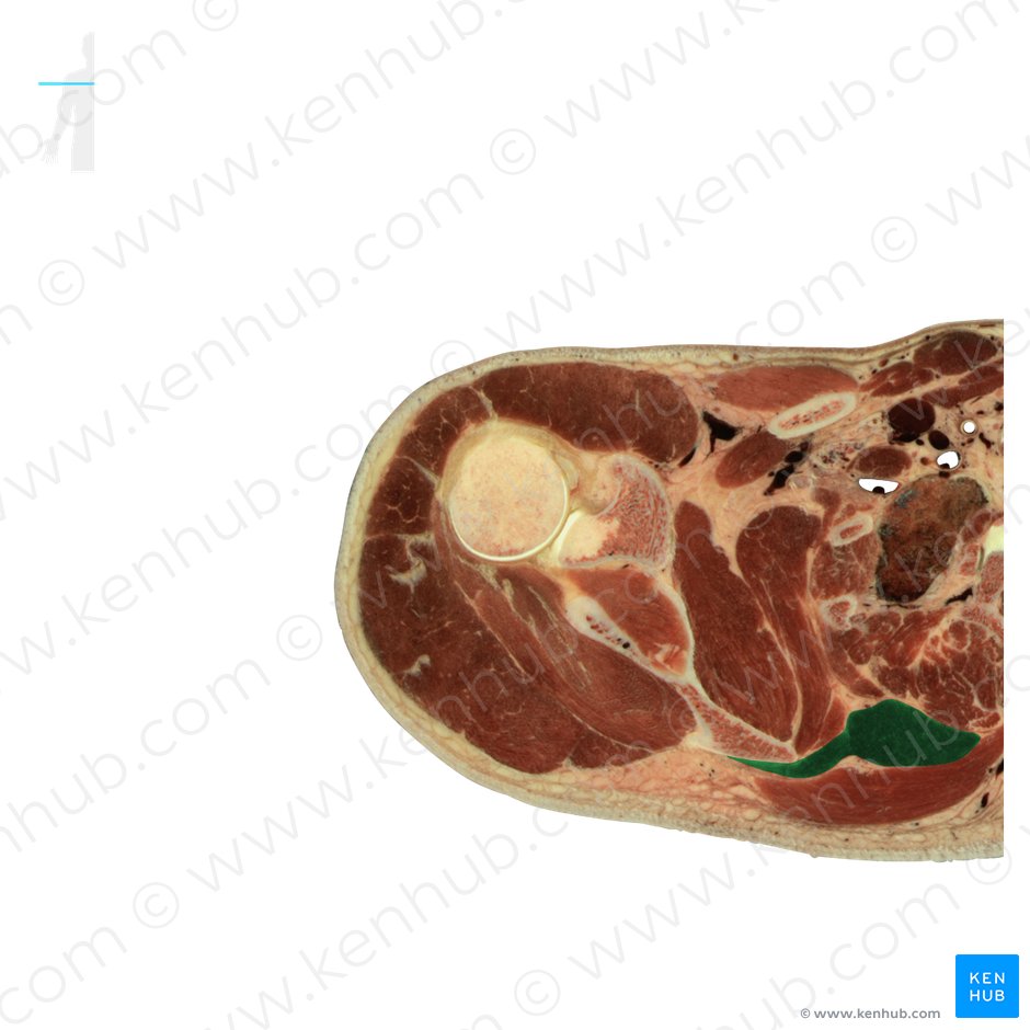 Rhomboid major muscle (Musculus rhomboideus major); Image: National Library of Medicine