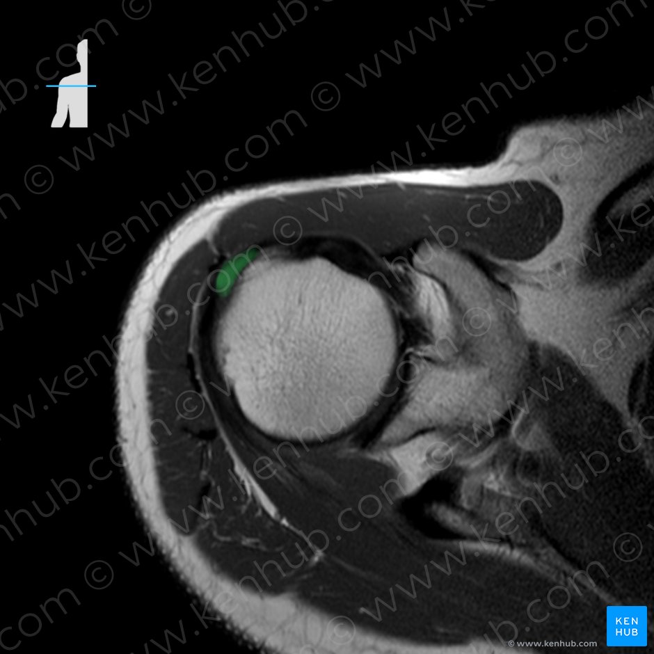 Tendo musculi supraspinati (Sehne des Obergrätenmuskels); Bild: 
