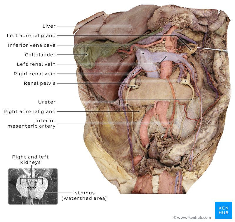 Cadaveric dissection of a horseshoe kidney