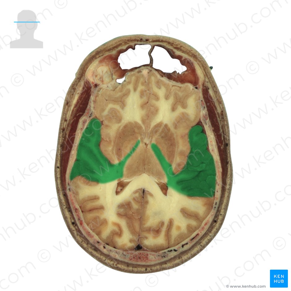 Temporal lobe (Lobus temporalis); Image: National Library of Medicine
