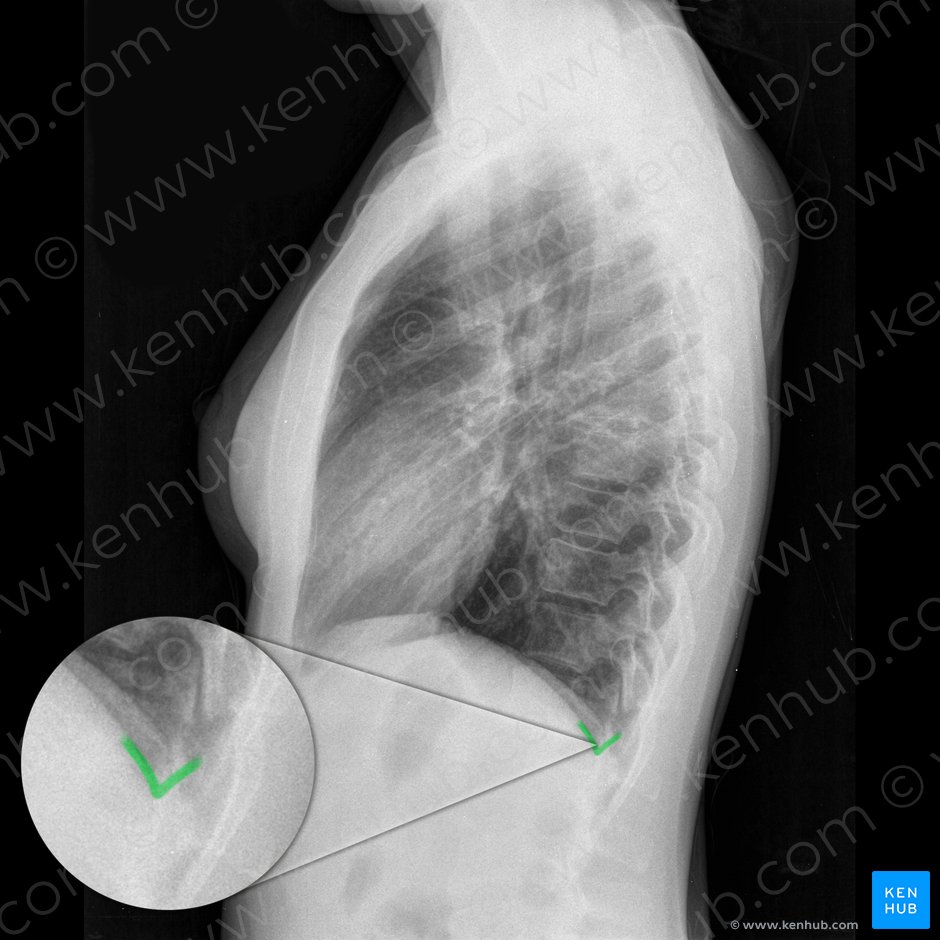 Right posterior costophrenic angle (Angulus costophrenicus posterior dexter); Image: 