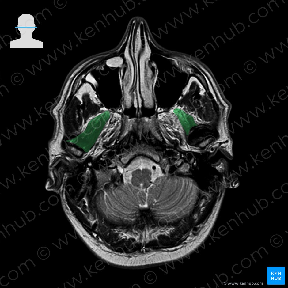 Lateral pterygoid muscle (Musculus pterygoideus lateralis); Image: 