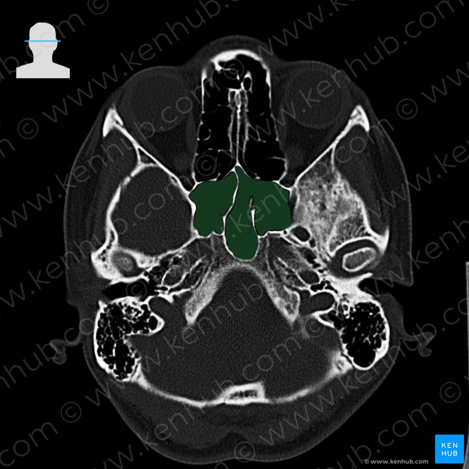 Sphenoidal sinus (Sinus sphenoidalis); Image: 