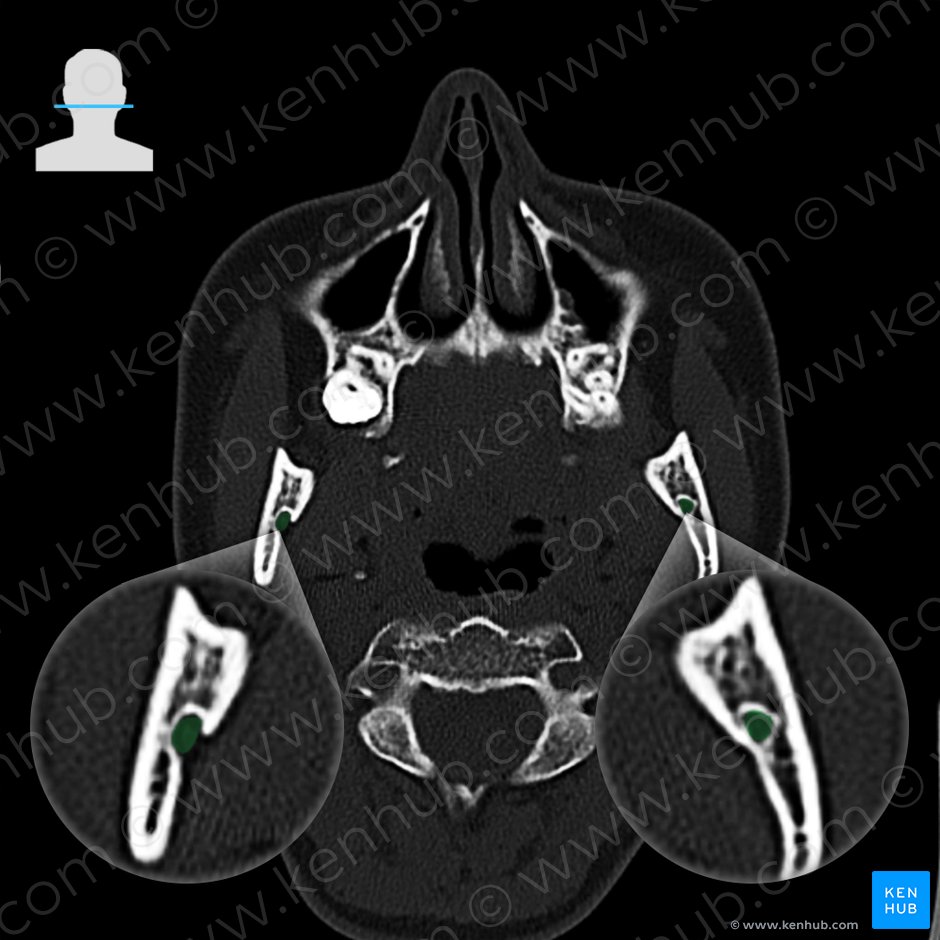 Foramen mandibulae (Unterkieferloch); Bild: 