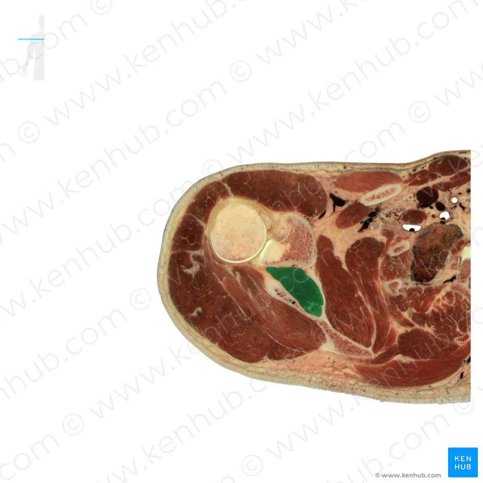 Supraspinatus muscle (Musculus supraspinatus); Image: National Library of Medicine