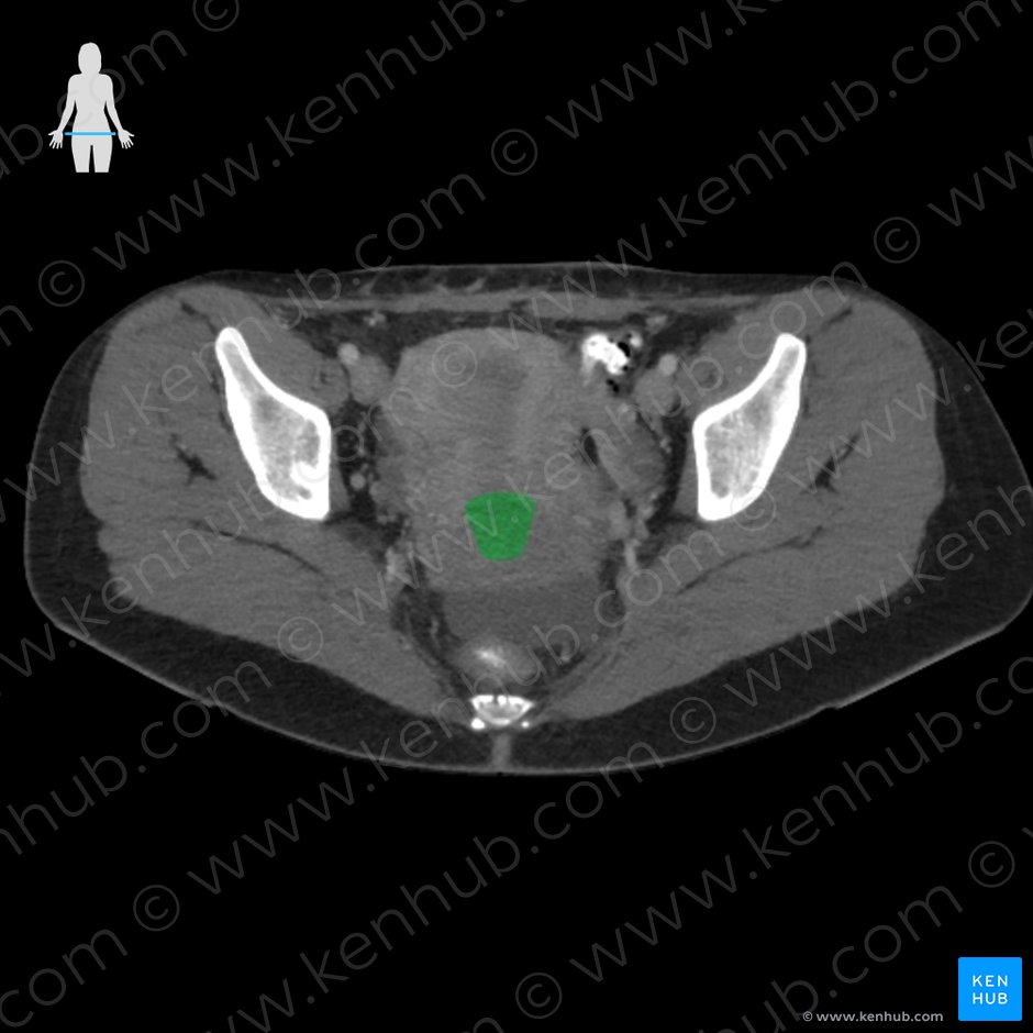 Cervix of uterus (Cervix uteri); Image: 
