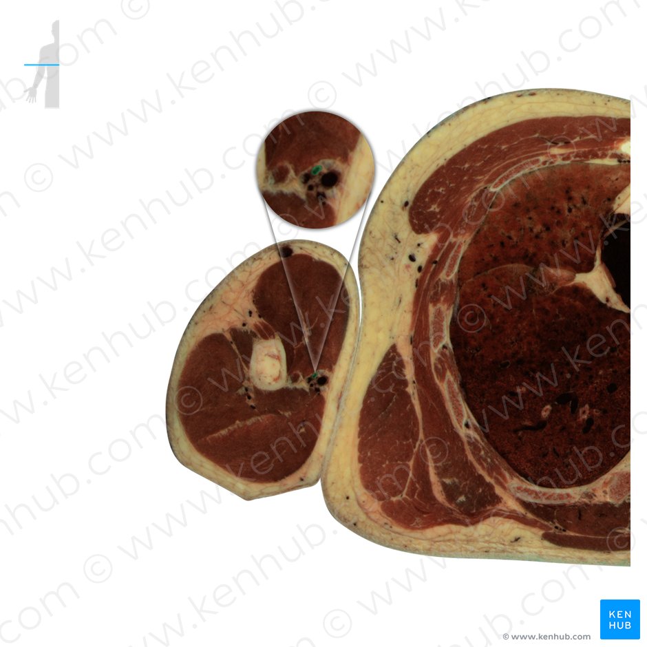 Artéria braquial (Arteria brachialis); Imagem: National Library of Medicine