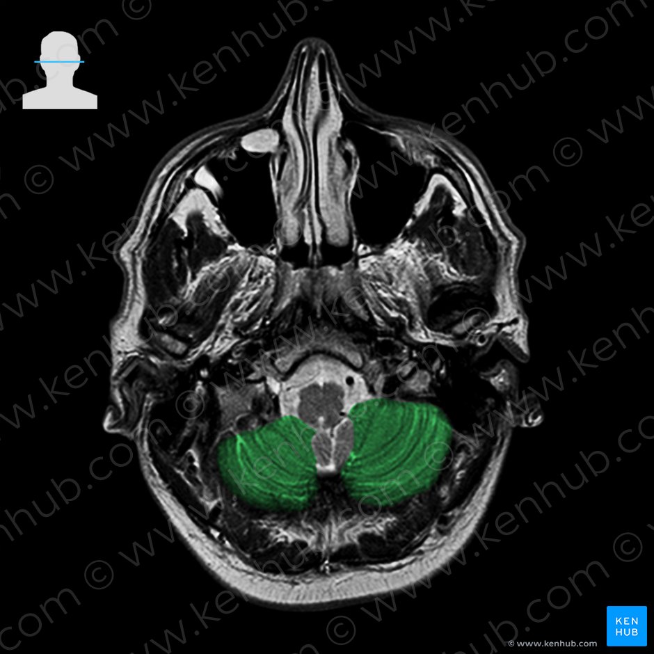 Posterior lobe of cerebellum (Lobus posterior cerebelli); Image: 
