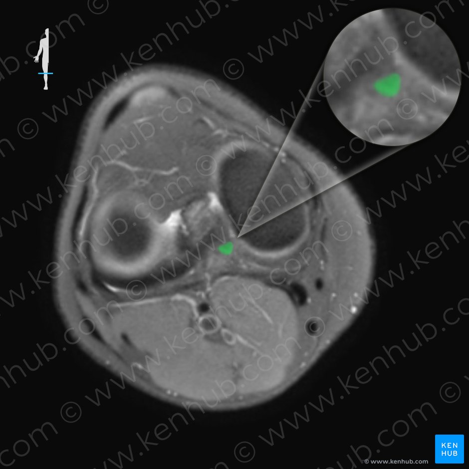Ligamento cruzado posterior (Ligamentum cruciatum posterius); Imagen: 