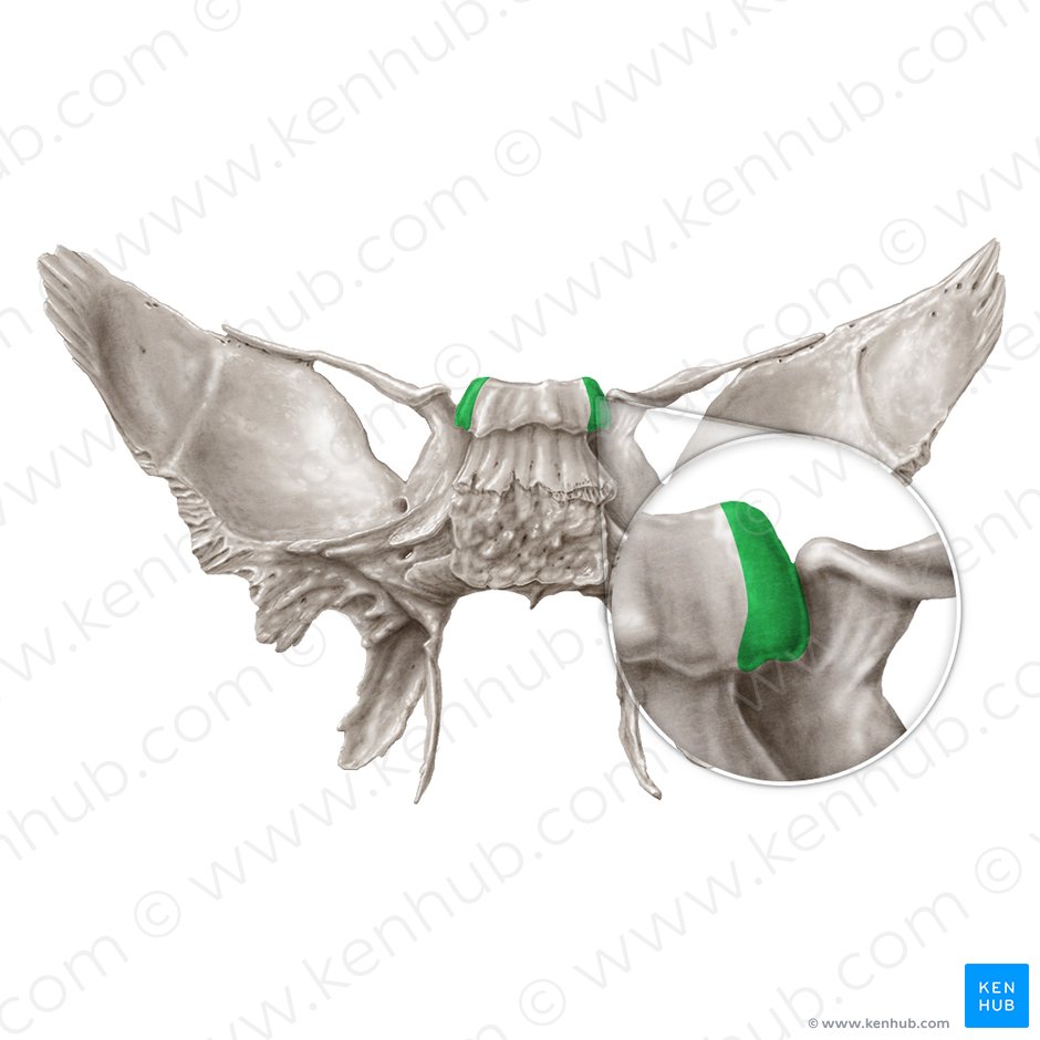 Processo clinoide posterior do osso esfenoide (Processus clinoideus posterior ossis sphenoidalis); Imagem: Samantha Zimmerman