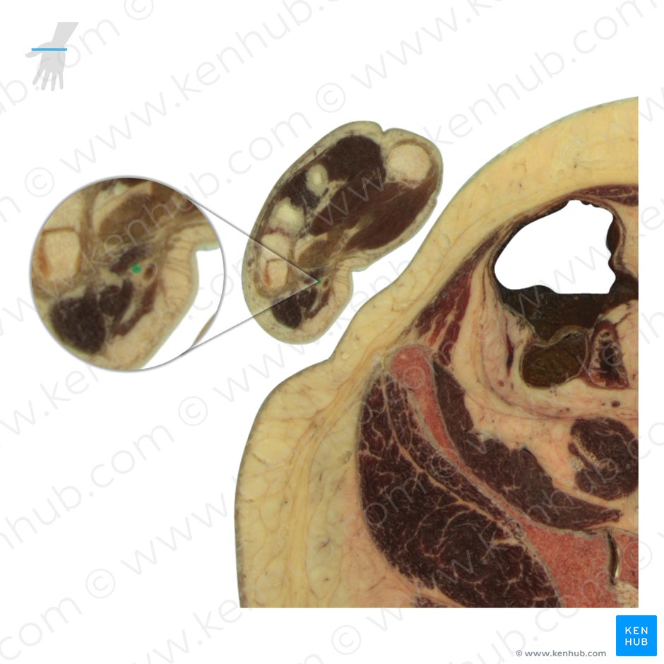 Ulnar nerve (Nervus ulnaris); Image: National Library of Medicine