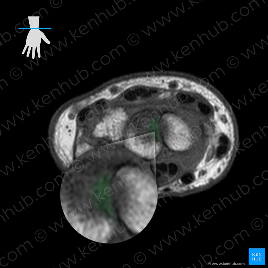 Interosseous intercarpal ligaments (Ligamenta intercarpea interossea); Image: 
