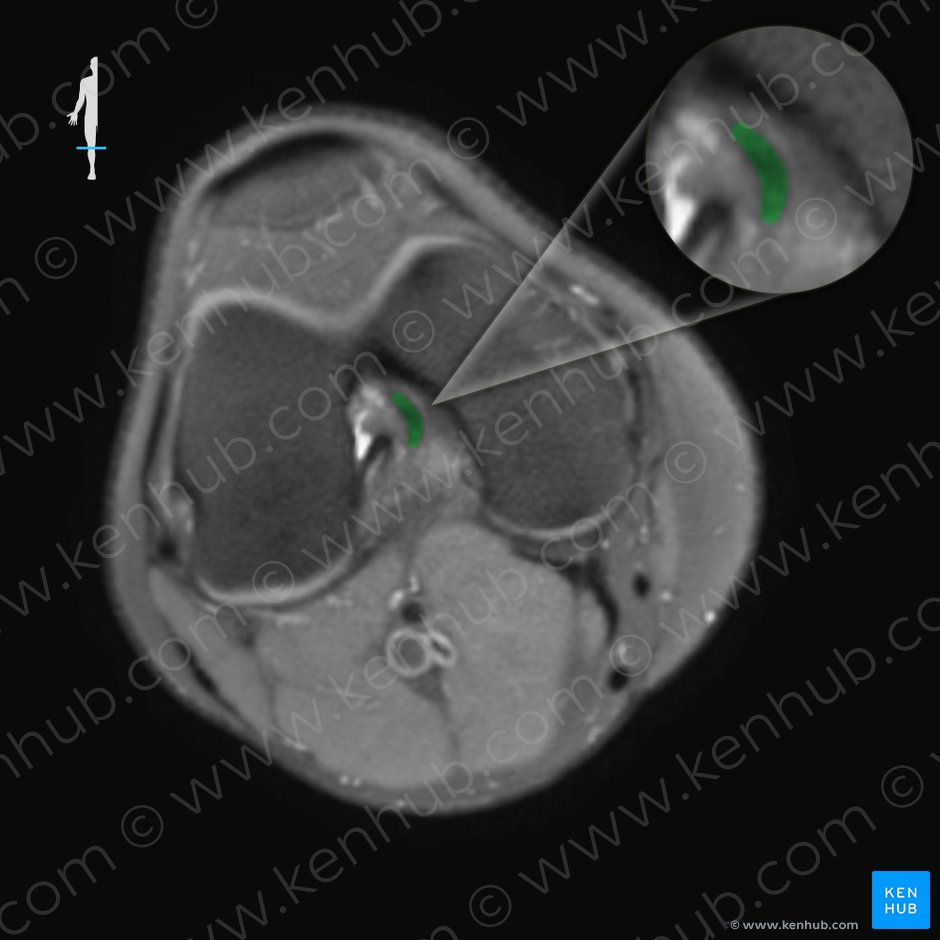 Posterior meniscofemoral ligament (Ligamentum meniscofemorale posterius); Image: 