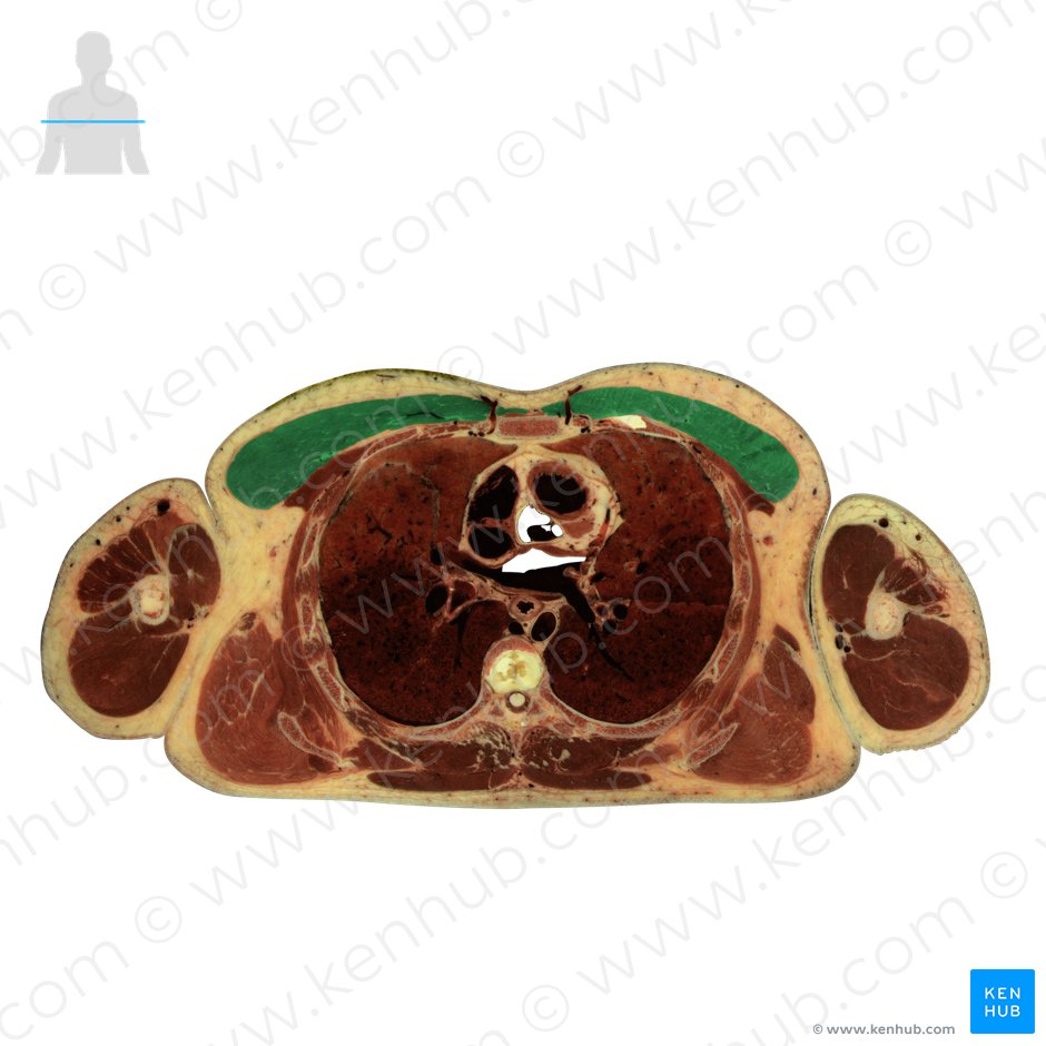 Músculo peitoral maior (Musculus pectoralis major); Imagem: National Library of Medicine