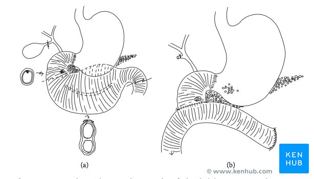 Schematic of duodenal duplication ressection