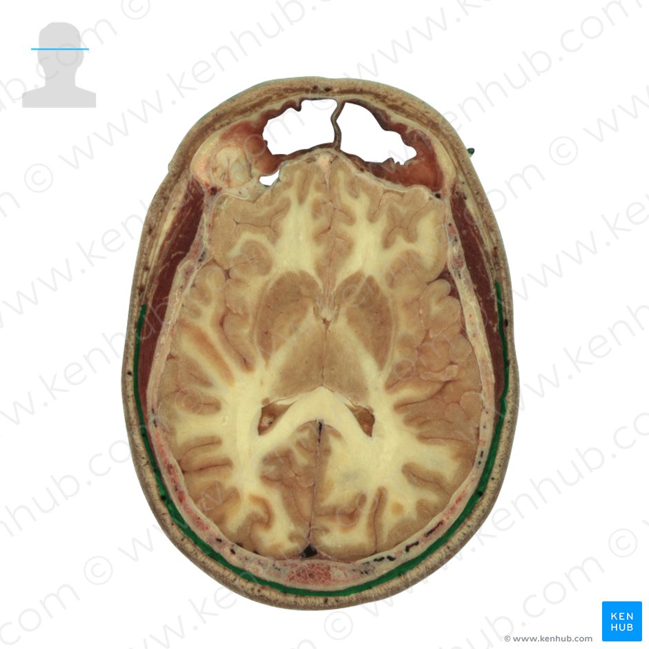 Epicranial aponeurosis (Galea aponeurotica); Image: National Library of Medicine