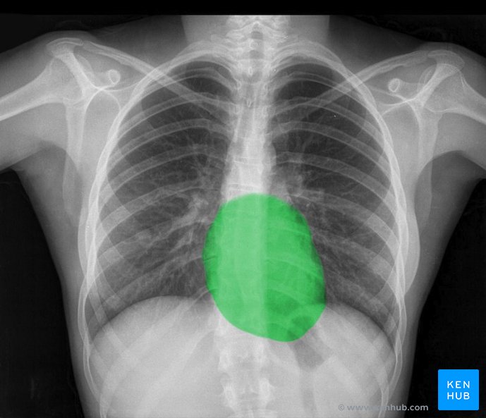 Normal chest x-ray: Anatomy tutorial | Kenhub