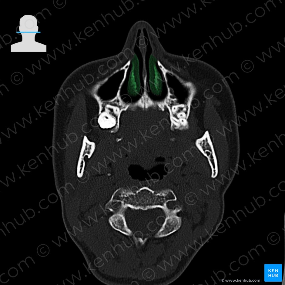 Concha nasalis inferior (Untere Nasenmuschel); Bild: 
