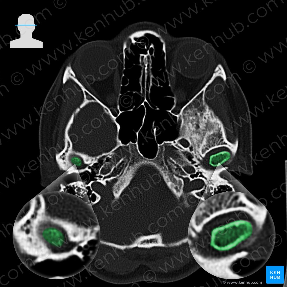 Head of mandible (Caput mandibulae); Image: 