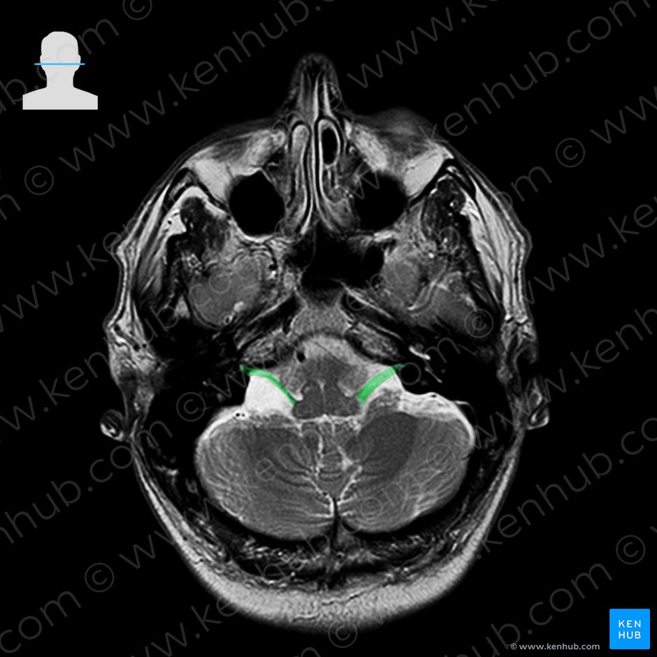 Nervio vestibulococlear (Nervus vestibulocochlearis); Imagen: 