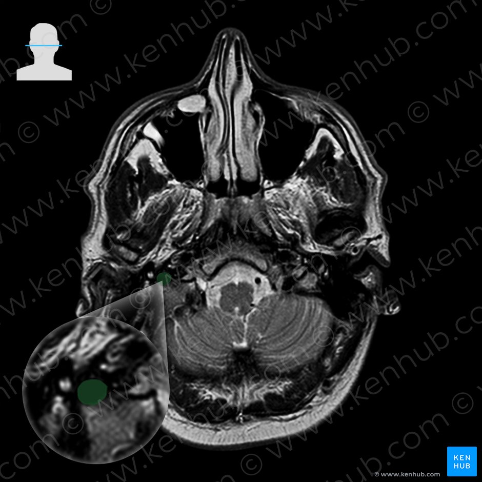 Right internal jugular vein (Vena jugularis interna dextra); Image: 