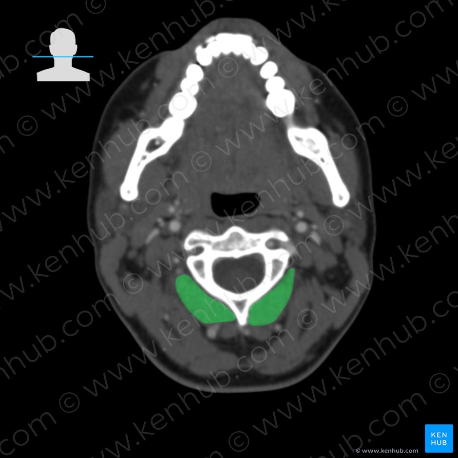 Musculus obliquus capitis inferior (Unterer schräger Kopfmuskel); Bild: 