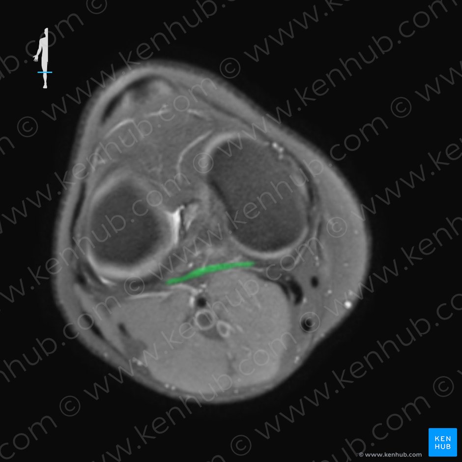 Oblique popliteal ligament (Ligamentum popliteum obliquum); Image: 