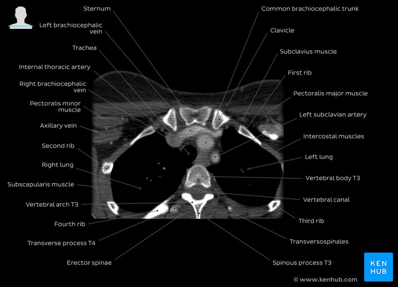 Chest CT overview: T3 level