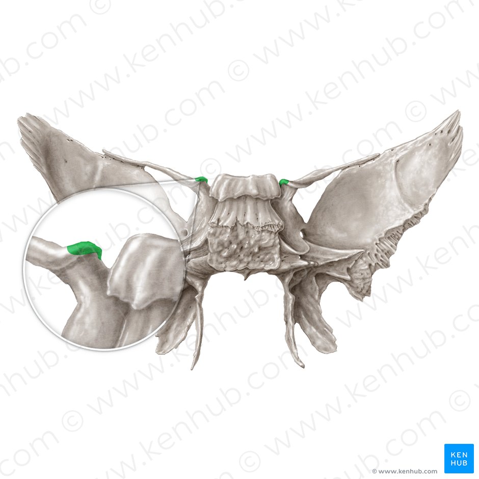 Processo clinoide anterior do osso esfenoide (Processus clinoideus anterior ossis sphenoidalis); Imagem: Samantha Zimmerman